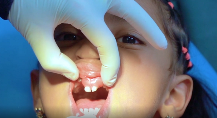 Labio o paladar fisurado